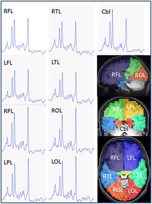 Altered Neurometabolic Profile in Early Parkinson's Disease: A Study With Short Echo-Time Whole Brain MR Spectroscopic Imaging